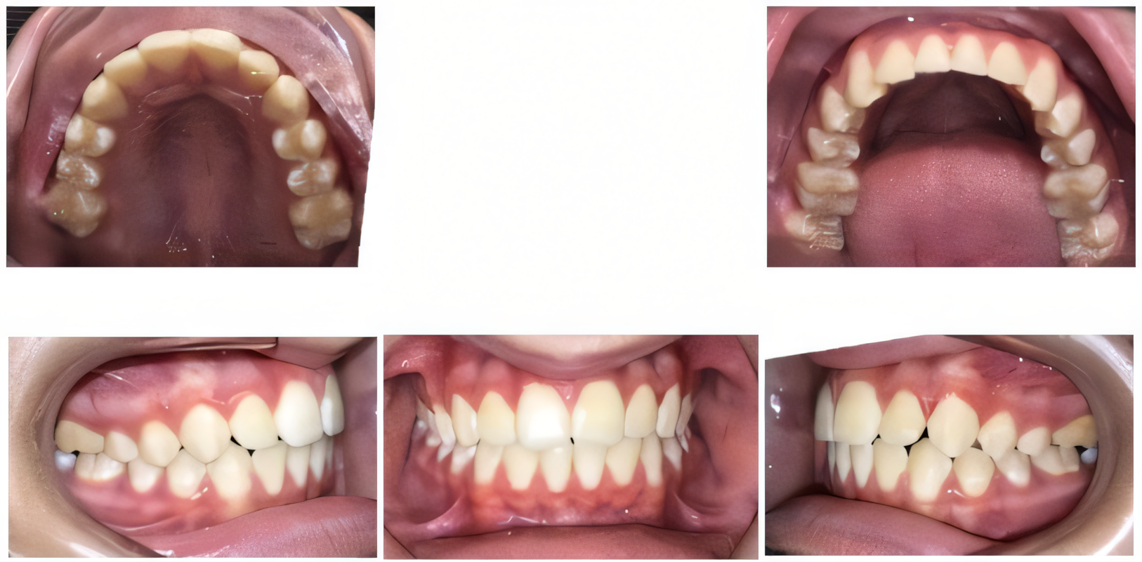 Phase 1 treatment after